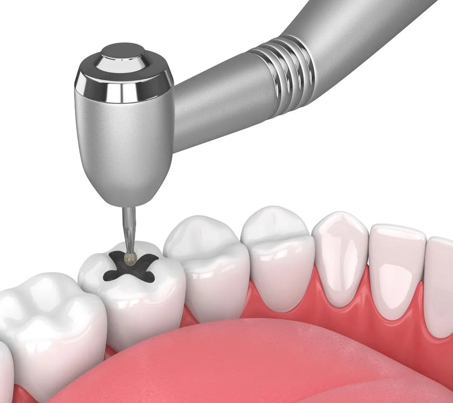 Everything You Need to Know About Tooth Fillings: Types, Benefits, and ...
