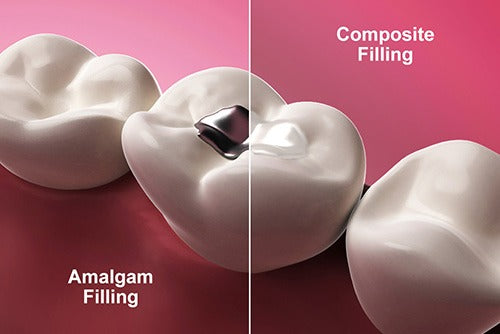 Perla Dental  Filling