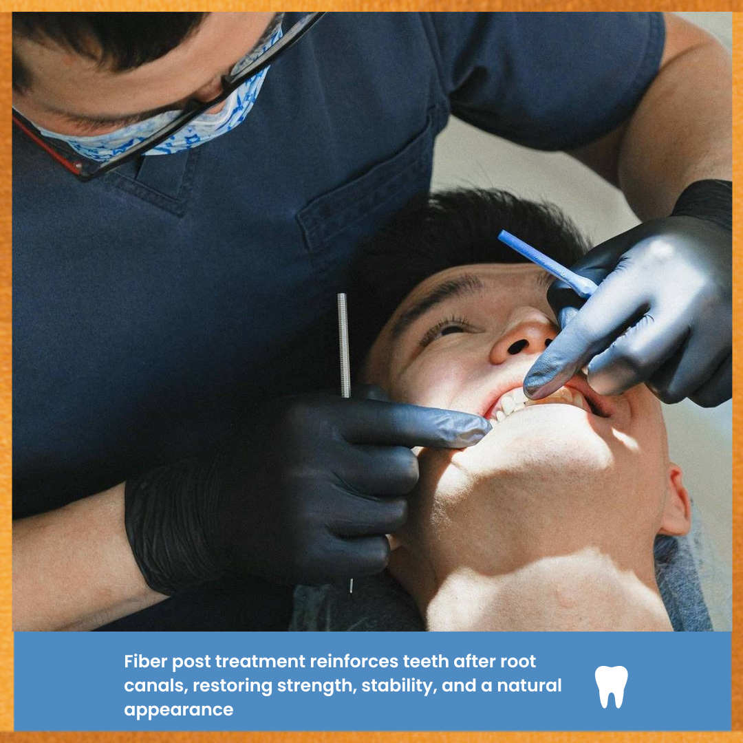 Endodontics Root Canal Treatment with Fiber Post – Strengthen and Rest ...