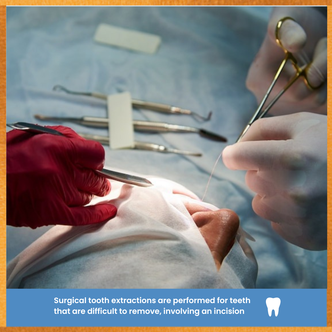 Tooth Extraction Methods Surgical Tooth Extractions (With Sutures) – Safe and Precise Removal f ...