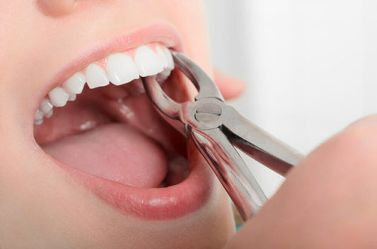 Perla dental Tooth Extractions 