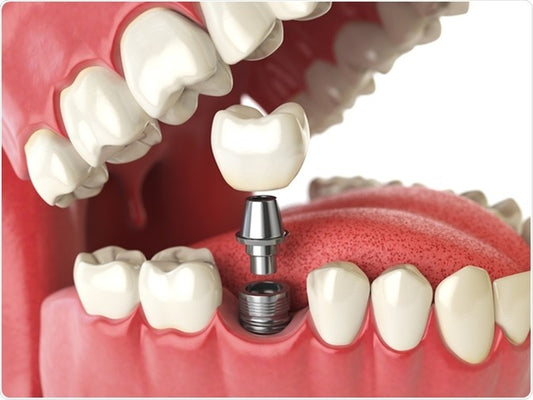 Perla Dental Dental Implants