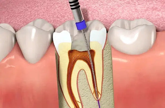 Perla Dental root canal